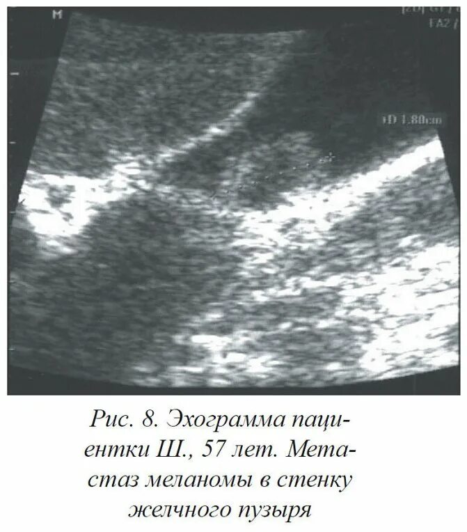 Холестероз желчного пузыря. Миоматоз желчного пузыря. Холестероз желчного пузыря эхограммы. Карцинома желчного пузыря УЗИ.