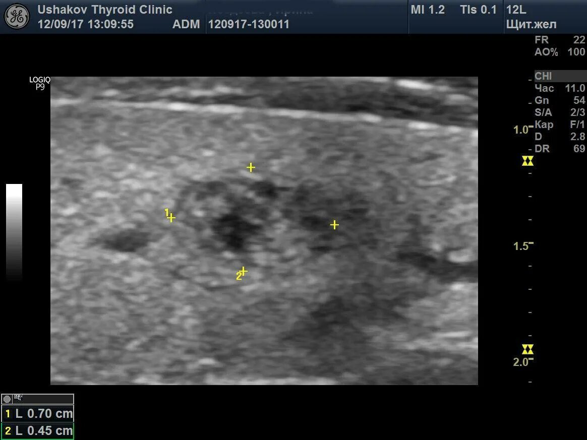 Щитовидная железа узлы в правой доле. Узел щитовидной железы 33.7. Микрокисты щитовидной железы. Аденома щитовидной железы на УЗИ. Измерение узлов щитовидной железы.