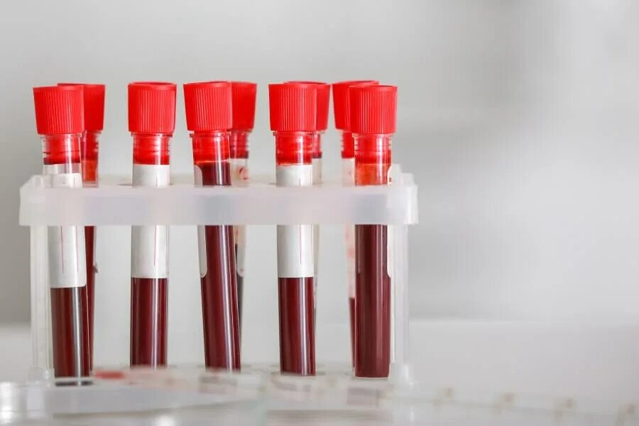 Кровь на ВИЧ цвет пробирки. Биохимические исследования крови пробирка. Пробирка для забора крови для биохимического исследования. Образец крови пробирка. Цвет вич