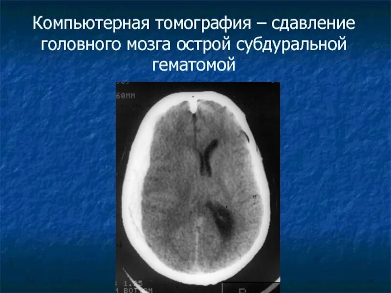 Гематома черепно мозговой травме. Эпидуральная гематома на кт. Кт головного мозга сдавление головного мозга. Субдуральная гематома.. Субдуральная гематома головного мозга мрт. Эпидуральная гематома сдавление головного мозга кт.