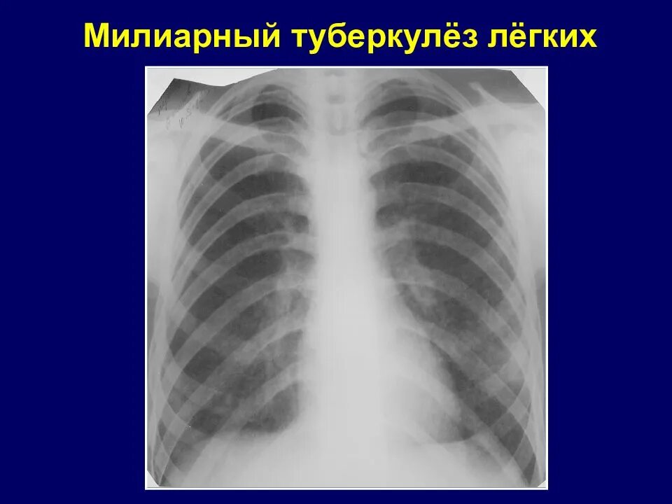 Милиарный диссеминированный туберкулез. Миллеальный туберкулёз.