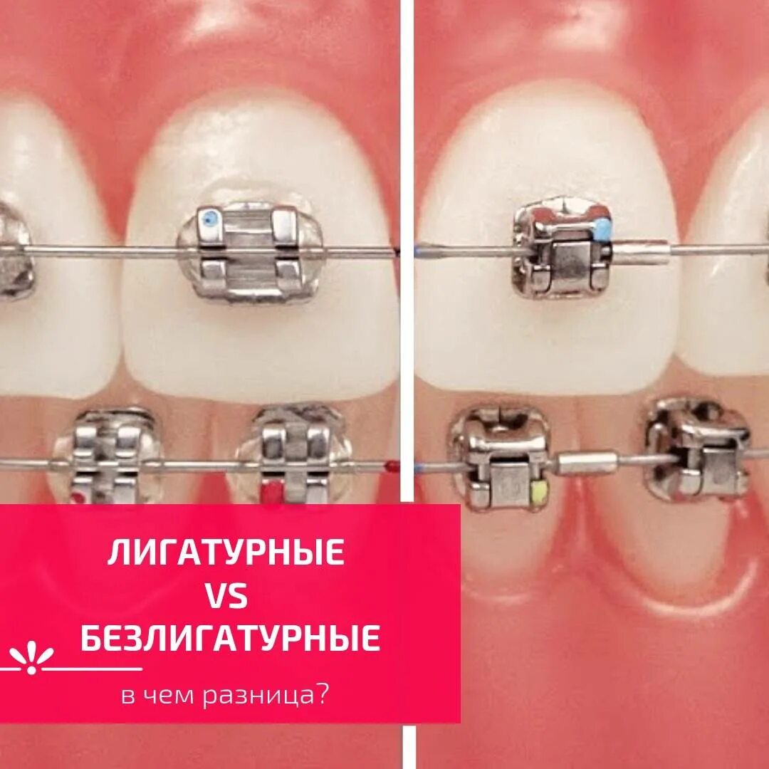 лигатурные и самолигирующие брекеты. безлигатурные брекеты h4. самолигирующие брекеты damon. лигатура и безлигатурные брекеты. безлигатурные брекеты damon q.