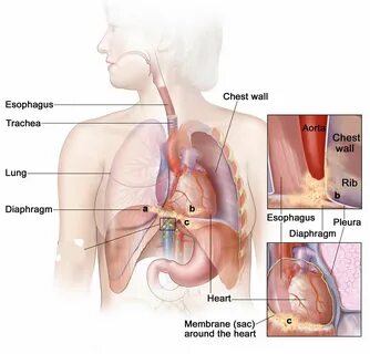 Esophageal cancer