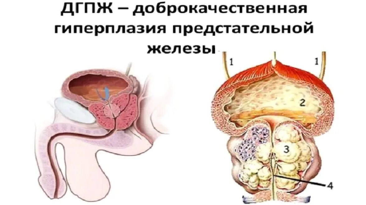 воспалительная болезнь предстательной железы. раковые клетки простаты. классификация заболеваний предстательной железы. предстательная железа у мужчин симптомы болезни. предстательная железа заболевания предстательной железы.