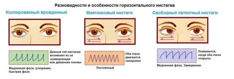 Спонтанный горизонтальный нистагм. Горизонтально ротационный нистагм. Врожденный горизонтальный нистагм. Глазной нистагм физиология.