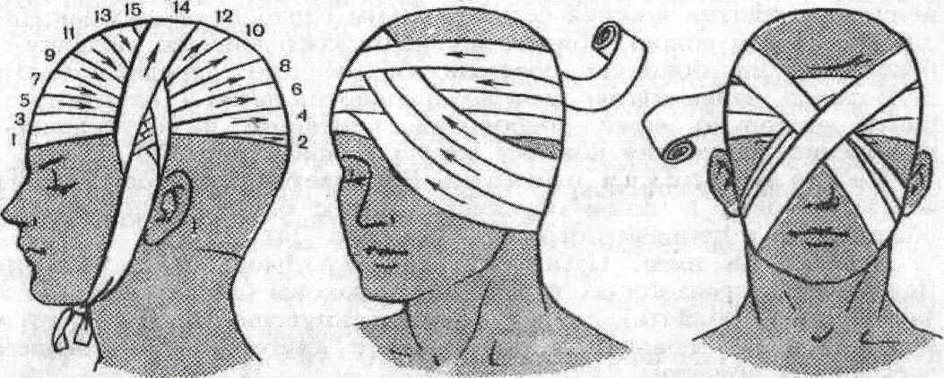 Как перевязывать голову. Бинтование головы чепец. Наложение повязки чепец. Перевязка головы бинтом чепец. Повязка на голову при травме чепец.