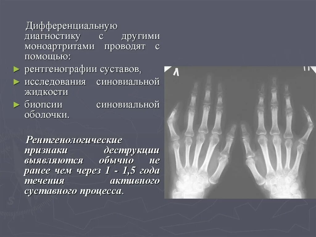 Рентген критерии ревматоидного артрита. Рентген заключение реактивного артрита. Рентген суставов псориатический артрит. Псориатический артрит локтевого сустава рентген. Артрит рентгенологические стадии