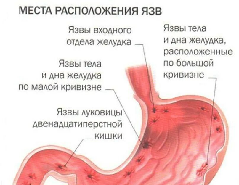 Язвы желудочно-кишечного тракта. Как ощущается желудок