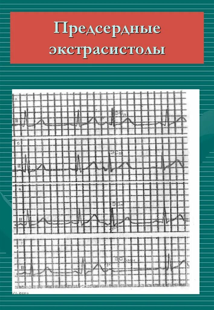 Блокированная предсердная экстрасистола. Блокированные предсердные экстрасистолы на ЭКГ. Одиночные предсердные экстрасистолы. Предсердная экстрасистола на стандартной ЭКГ. Блокированные экстрасистолы