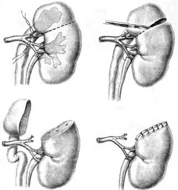 Резекция почки что это. Удвоение ЧЛС почки. Гидронефроз почки операция операция. Удвоение полостной системы левой почки. Геминефрэктомия удвоенной почки.