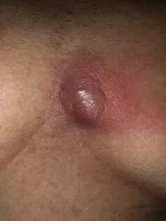 Red spot on breast looks like hickey.