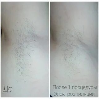 Электроэпиляция лучшие