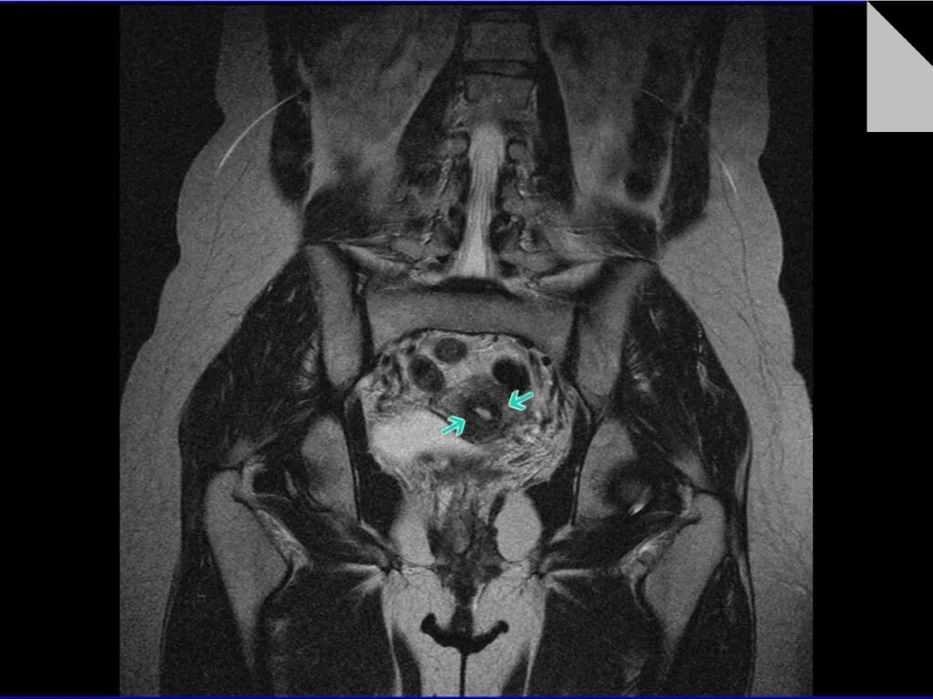 переломы костей таза кт. малый таз на кт томограмма. флеболиты в малом тазу на кт. мрт омт с контрастированием. кт малого таза без контраста.