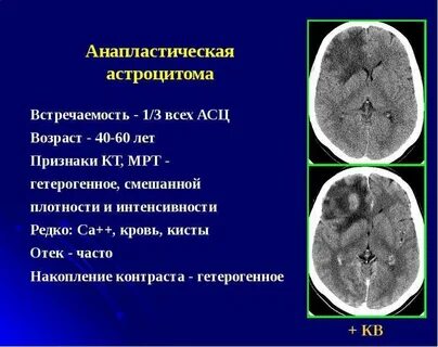 Астроцитома прогноз после операции