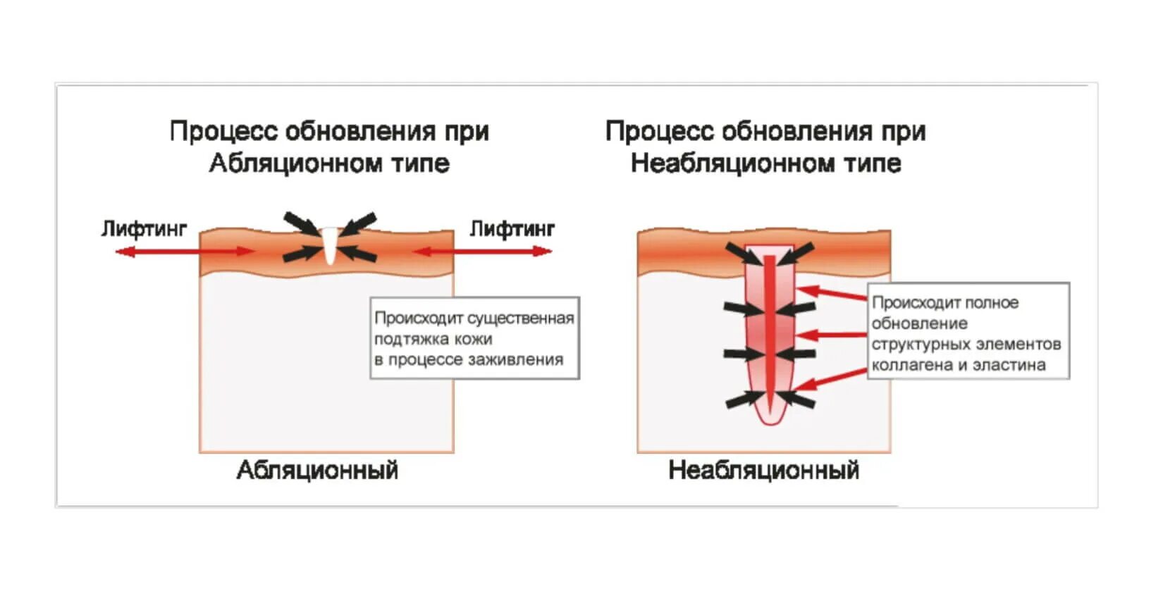 Аппарат лазер со2 Назначение. Фракционное лазерное омоложение со2. Процедура со2 лазерного омоложения.