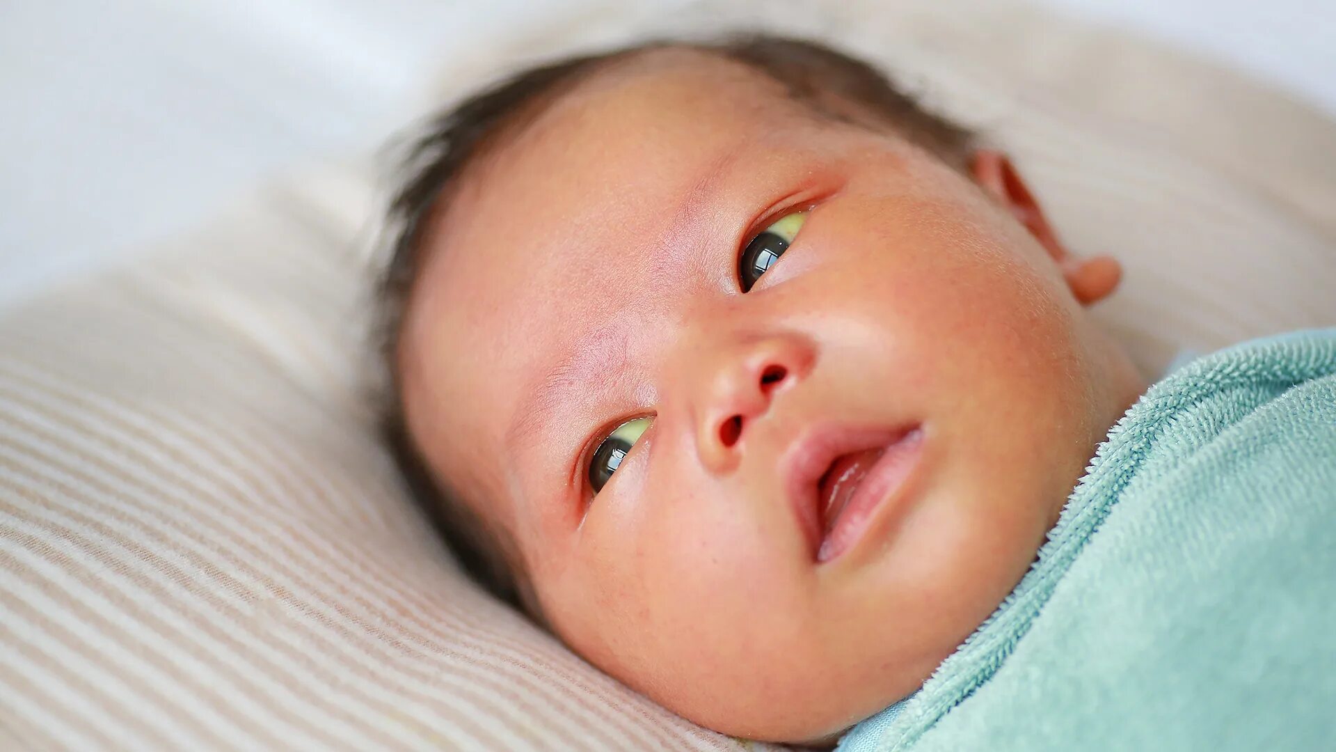 Почему у новорожденного глазки. Желтушка у новорожденных. Иктеричность склер у новорожденных. Желтушка у новорожденных глаза. Желтушка у новорожденных 21.