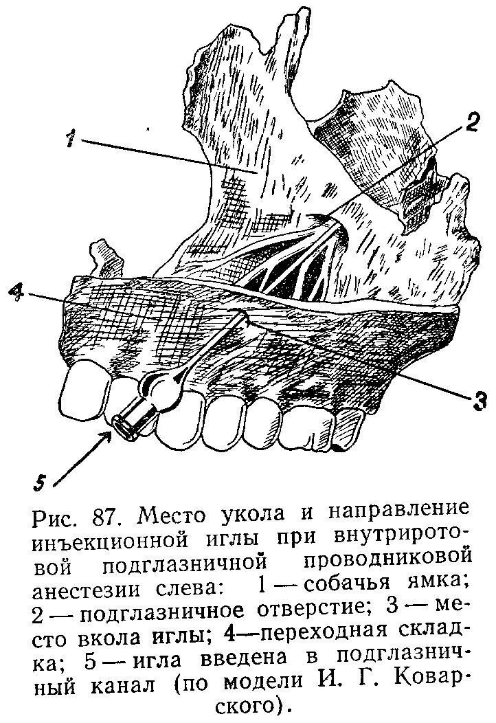 Подглазничная анестезия. Проводниковая анестезия пальца стопы. проводниковая подглазничная анестезия. проводниковая анестезия нижней челюсти.
