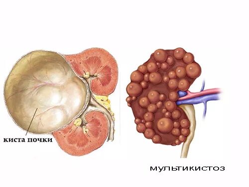 Киста в почке у мужчин причины