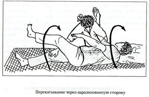 Лева левая сторона после инсульта в