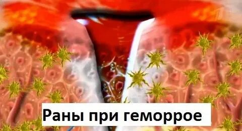 Частый клинический признак при геморрое