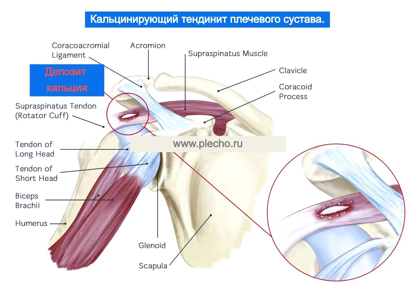 Разрыв надостной мышцы лечение. Вращательная манжета плечевого сустава анатомия. Тендиноз вращательной манжеты плечевого сустава. Кальцифицирующий тендинит надостной мышцы плечевого сустава. Ротаторная манжета плечевого сустава мышцы.
