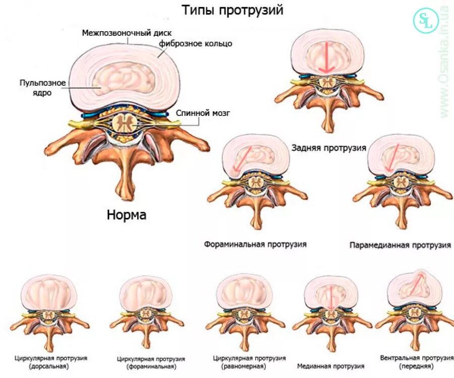 Медианно парамедианная билатеральная. Дорзальная диффузная протрузия межпозвонкового диска l5-s1. Протрузии диска l5-s1. Классификация грыж позвоночника по локализации. L4-5 задняя циркулярная протрузия.