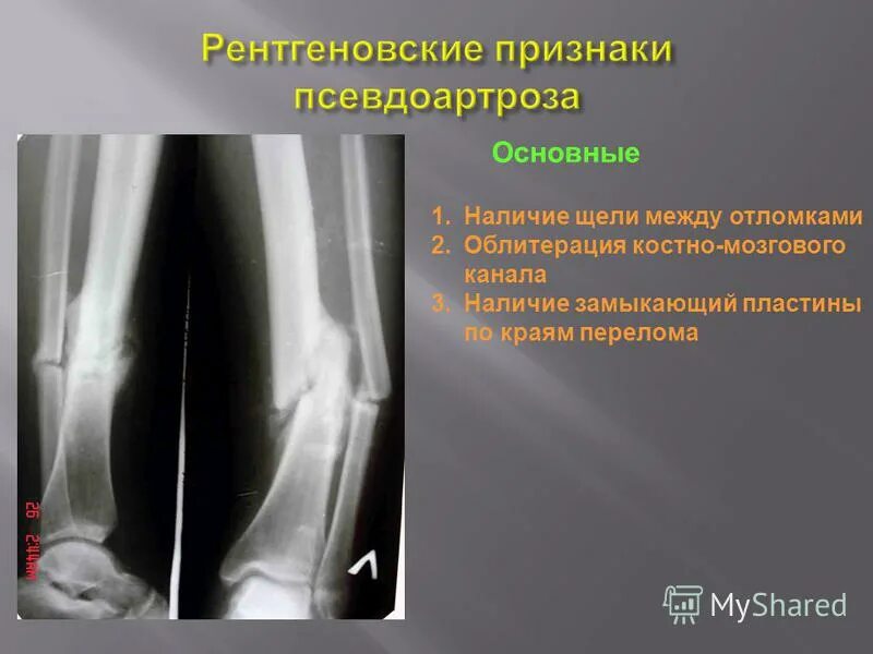 ложный сустав большеберцовой кости. ложный сустав рентген. ложный сустав рентген. ложный сустав бедренной кости. ложный сустав рентген признаки.