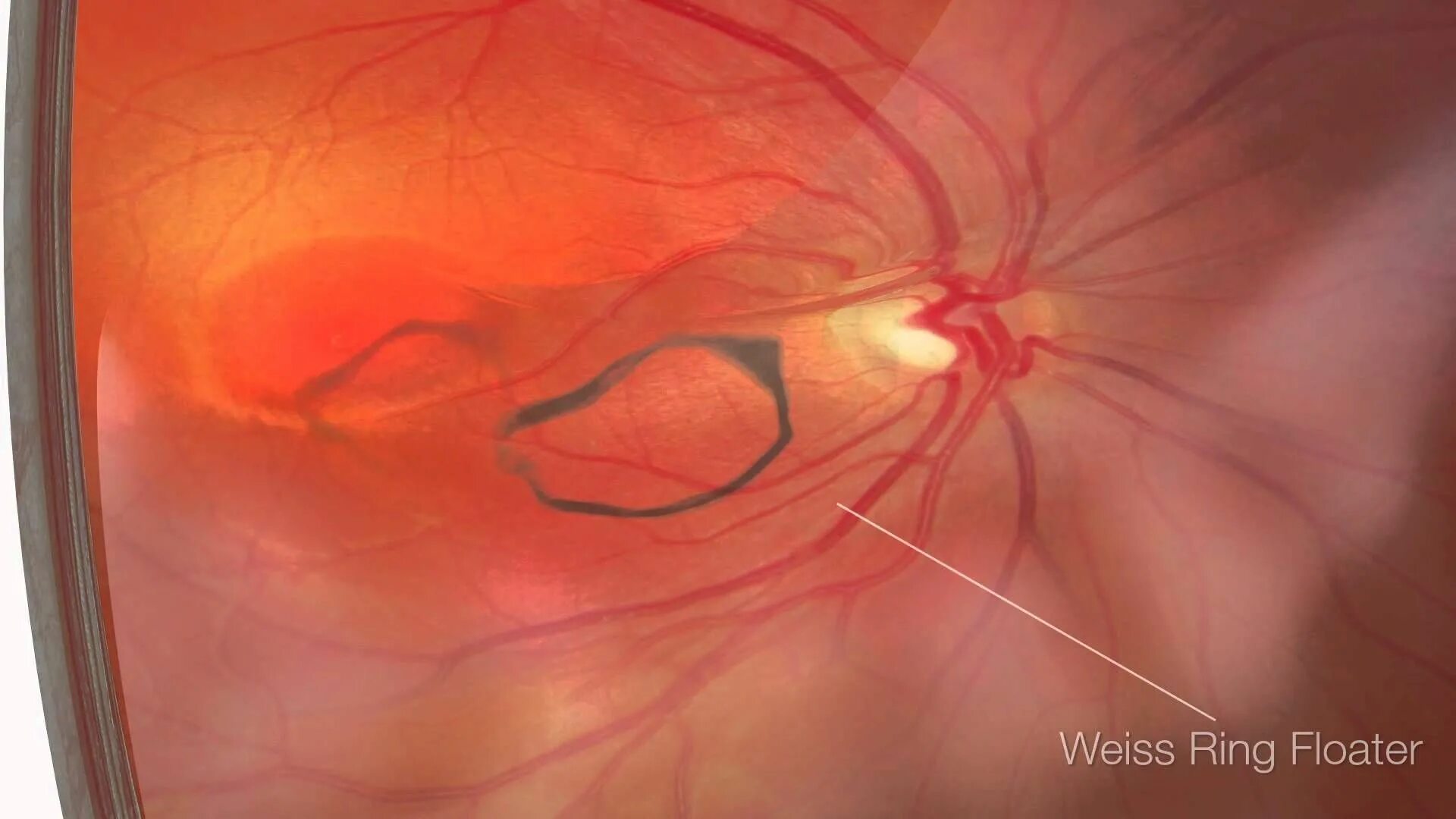 Кольцо Вейса отслойка стекловидного тела. Деструкция стекловидного тела кольцо Вейса. Задняя отслойка стекловидного тела кольцо Вейса. Отслойка сетчатки офтальмоскопия. Прозрачное тело в глазу