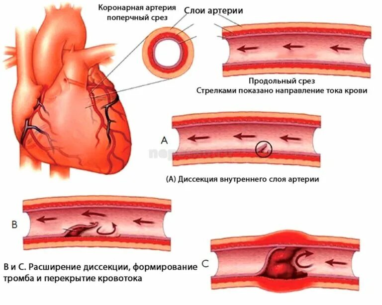 Осложнения стентирования коронарных артерий сердца. Инфаркт миокарда стентирование осложнения. ИБС атеросклероз коронарных артерий. Стентирование коронарных сосудов осложнения. Тромб в правом