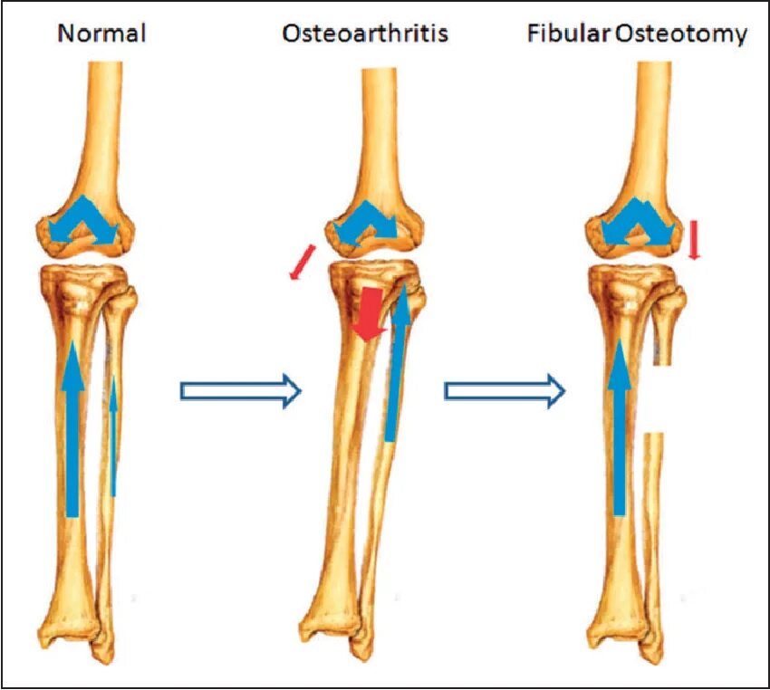 Остеотомия малоберцовой кости. Остеотомия малоберцовой кости при артрозе коленного сустава. Резекция кости большеберцовой кости. Корригирующая остеотомия малоберцовой кости.