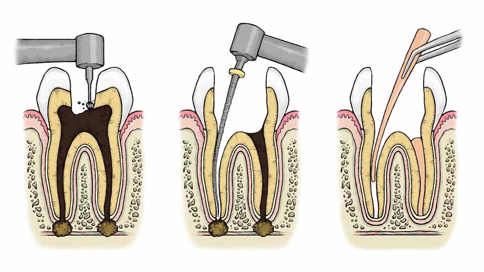 Временное пломбирование каналов зуба. Перепломбировка каналов зуба. Запломбированные корневые каналы зуба. Пломбирование 1 корневого канала. Корневые каналы обтурированы.