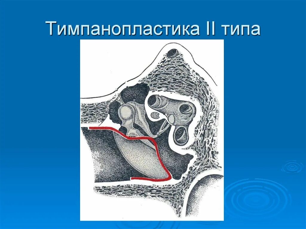 Тимпанопластика отзывы. Тимпанопластика, мирингопластика. Тимпанопластика среднего уха.