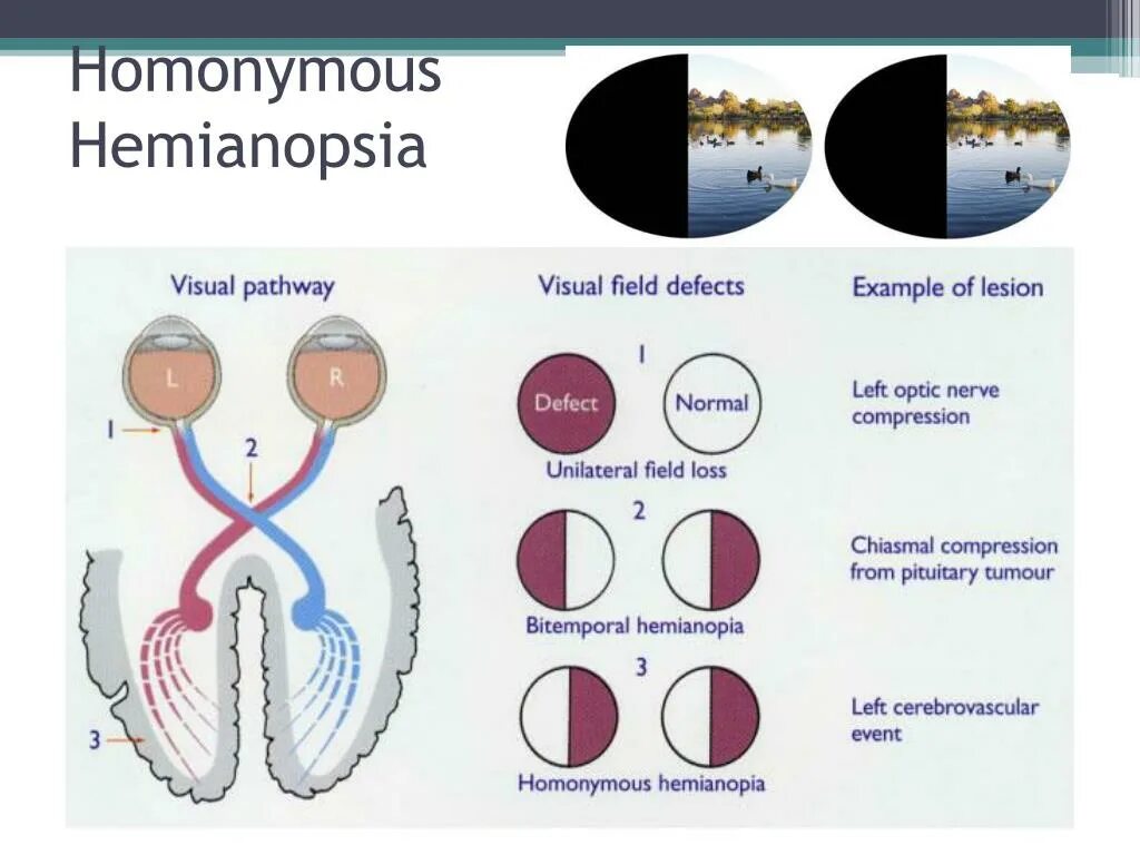 Битемпоральная гемианопсия. Правосторонняя гомонимная гемианопсия. Левосторонняя гомонимная гемианопсия. Битемпоральная гетеронимная гемианопсия. Монимен