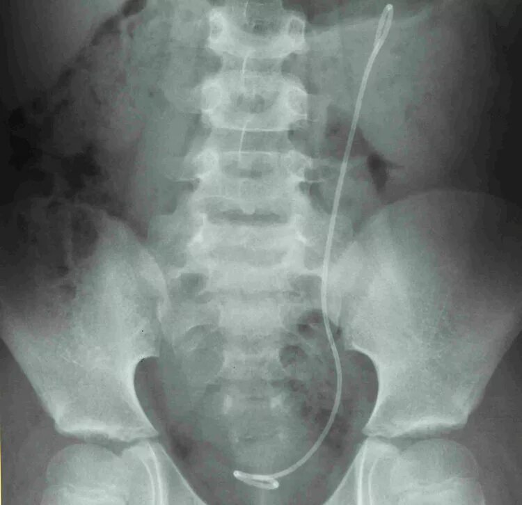 Катетер стент мочеточниковый. После стентирования мочеточника. Стентирование при камне мочеточника. После стентирования мочеточника. После стентирования мочеточника.