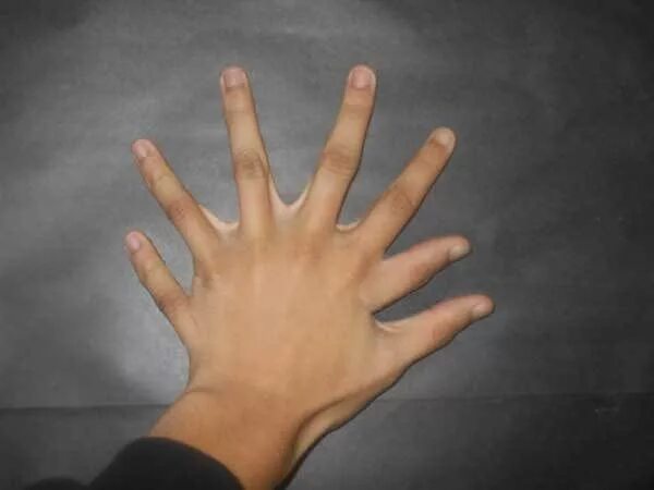 Четыре пальца на руке. Клинодактелия мезинца. Радиальная преаксиальная полидактилия.