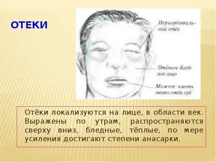 Как убрать утренние отеки лица