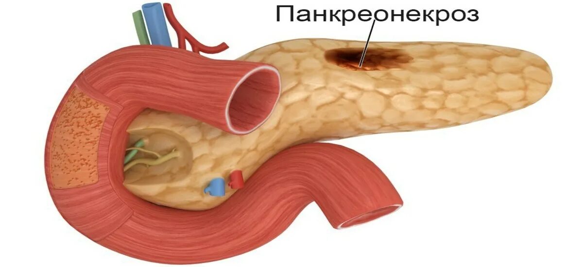 Что такое некроз поджелудочной железы у мужчин. Панкреатический некроз поджелудочной. Стерильный панкреонекроз. Геморрагический панкреонекроз поджелудочной. Тотальный геморрагический панкреонекроз.