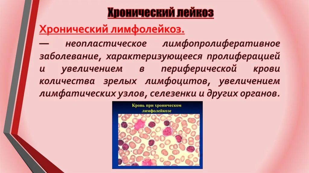 В -лимфоциты хронический лимфолейкоз. Острый лейкоз и хронический лимфолейкоз. Хронический лимфолейкоз характеризуется. Хронический лимфолейкоз лимфатические узлы.