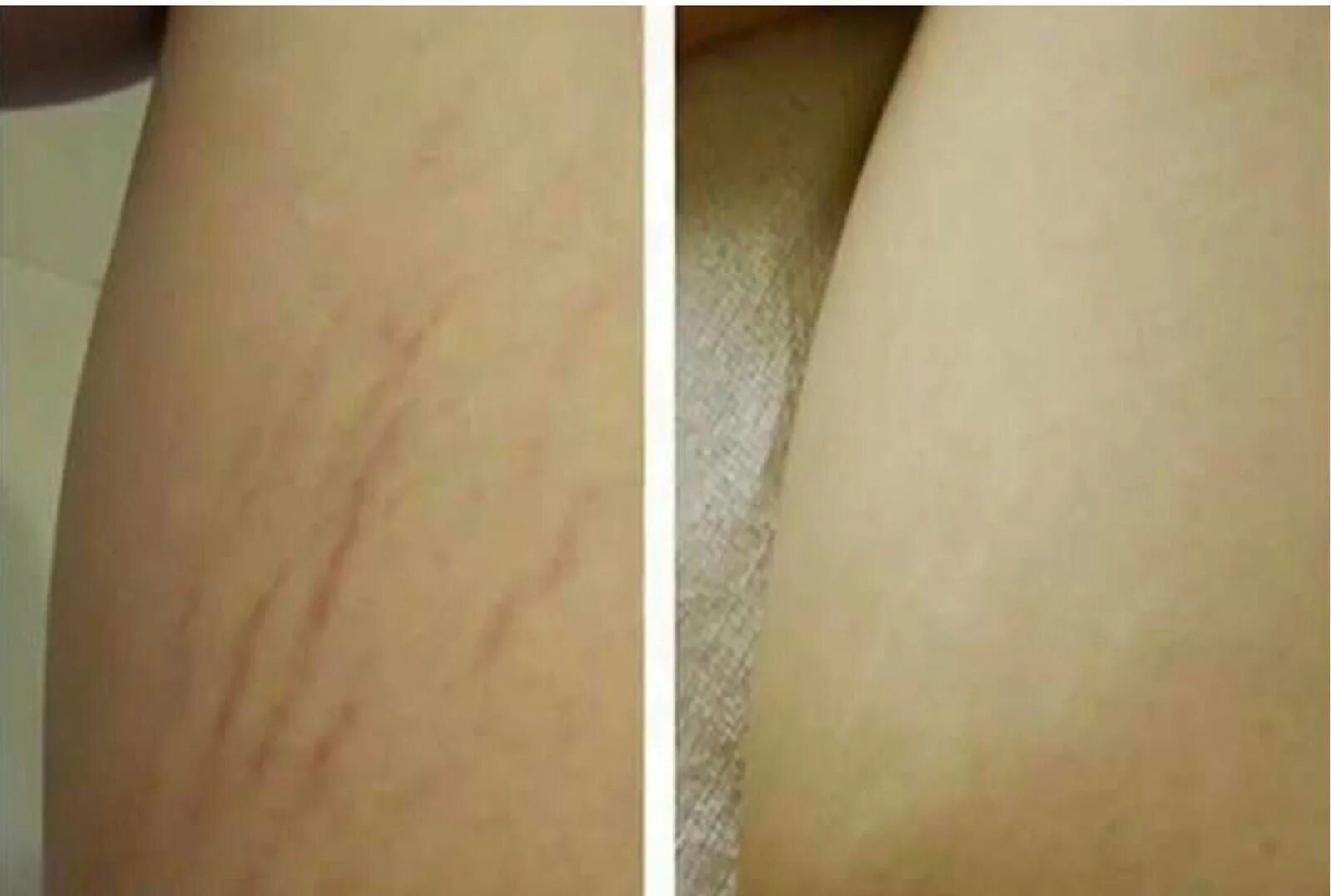 Как избавиться от растяжек на ягодицах