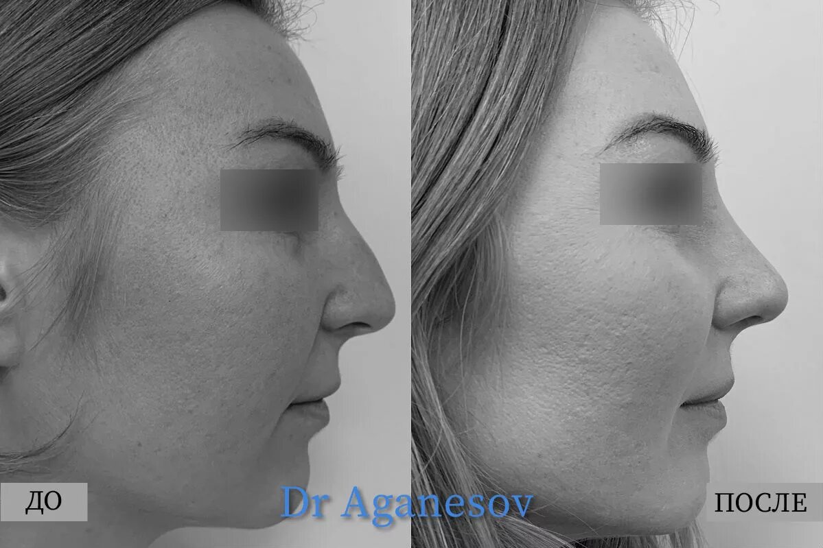 ринопластика спинка носа. ринопластика спинка носа. ринопластика спинка носа. ринопластика спинка носа. аганесов пластический хирург ринопластика.