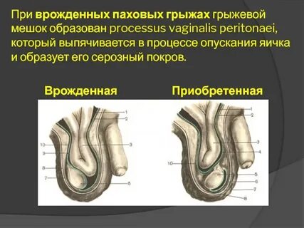 Паховая грыжа у новорожденных мальчиков