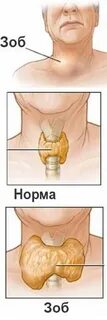 Уровень диффузного зоба