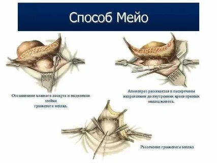 Пупочная герниопластика
