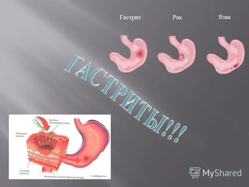 Дуодено-гастральный рефлюкс. Ffуоденогастральный рефлюкс". Гастрит дуодено гастральный рефлюкс. Антральный рефлюкс