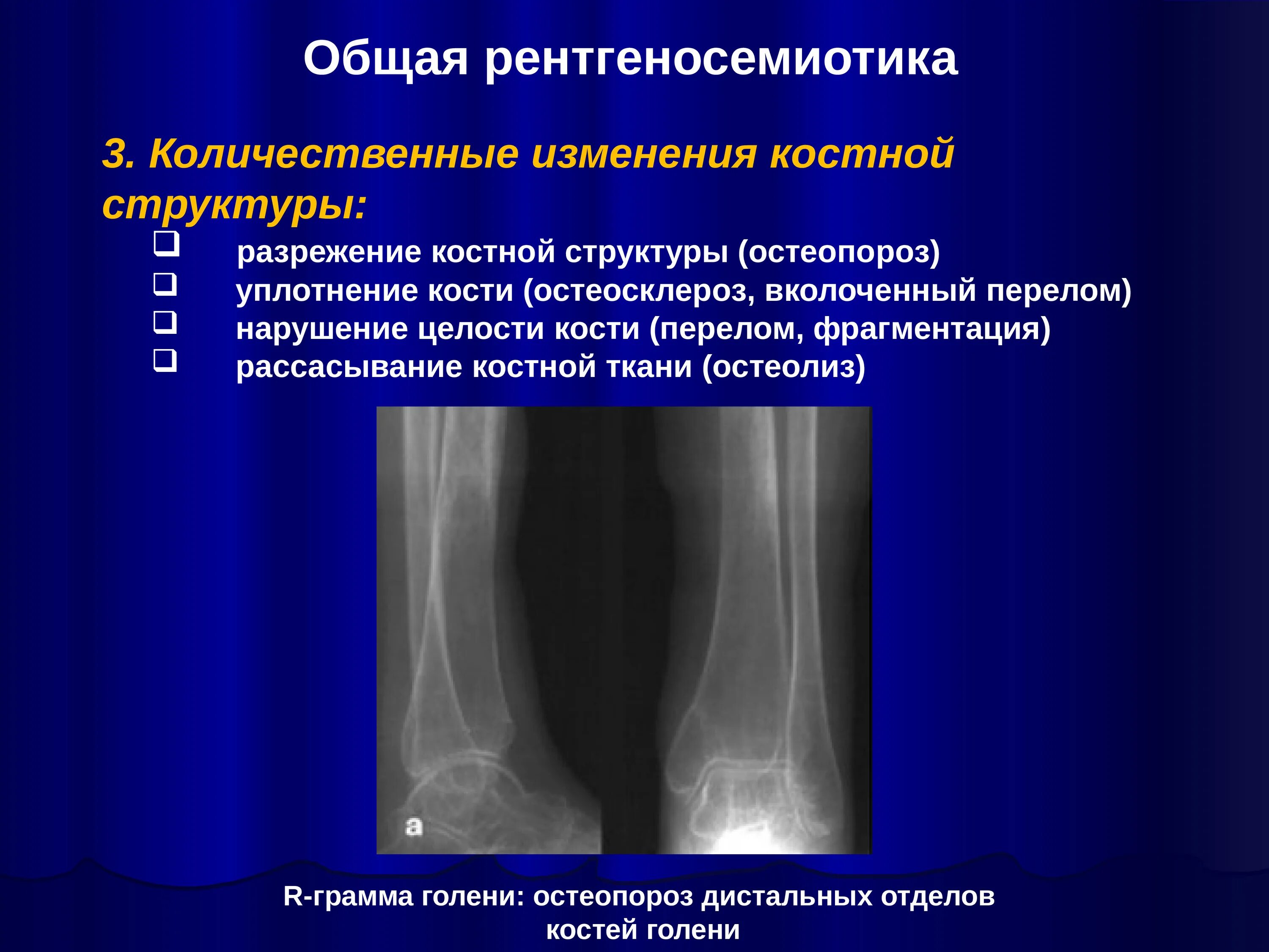 Изменение структуры кости. Остеопороз костей голени рентген. Рентгенодиагностика перелом кости. Участки разрежения костной ткани. Остеопороз и остеосклероз.