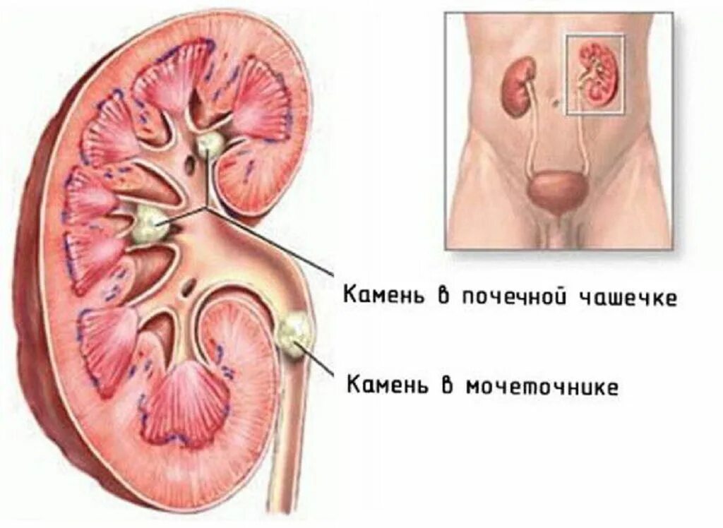 Камень в лоханке почки 8мм. Мочекаменная болезнь расположение камней. Камни почек и мочеточников. Симптомы.