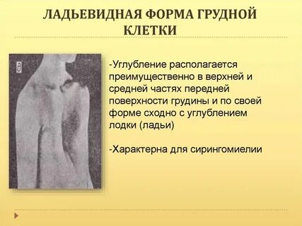 Пороки грудной клетки