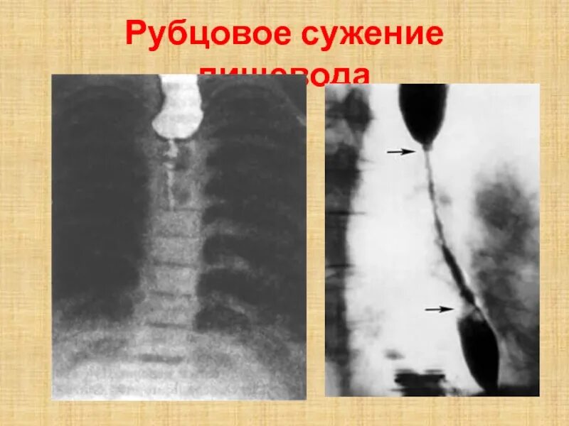 Субкомпенсированный стеноз пищевода. Рубцовые сужения пищевода классификация. Рубцовое сужение пищевода рентген. Декомпенсированный стеноз пищевода.