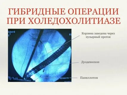 Холедохолитиаз диагностика