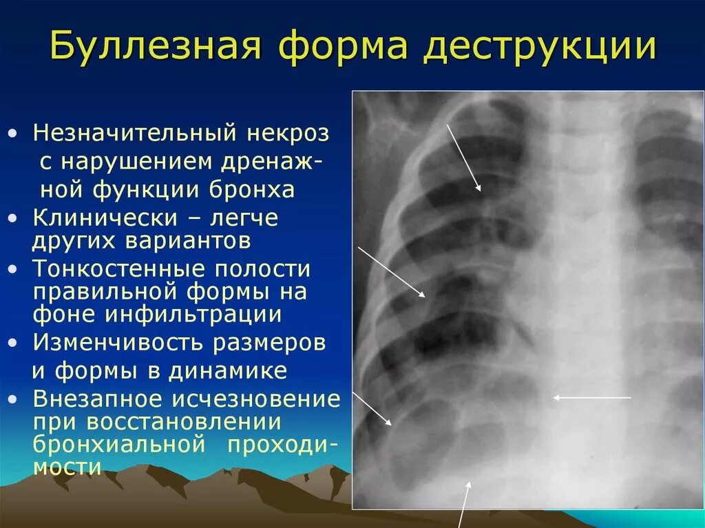 Образование полостей в легких